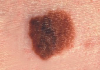 Os melanomas geralmente são maiores em diâmetro, mas podem ser menores quando detectados pela primeira vez. Foto: The Skin Cancer Foundation